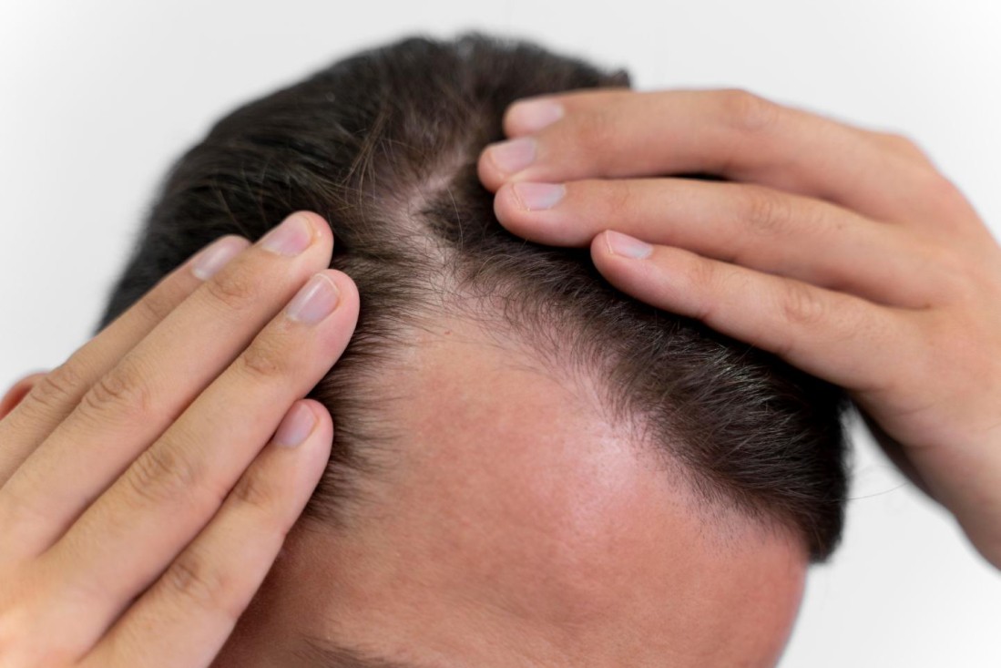 Alopecie difuză - dinamica efluviului telogen, de la declanșare la regenerare