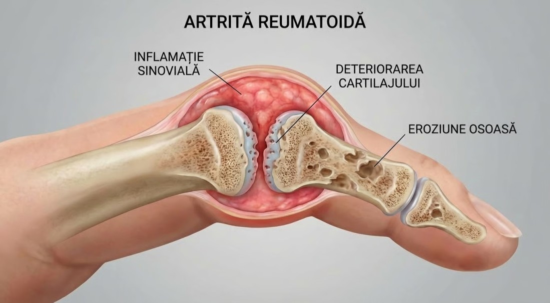 Artrita reumatoidă (Poliartrita Reumatoidă): de ce apare, care sunt simptomele și cum poate fi tratată