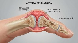 Artrita reumatoidă (Poliartrita Reumatoidă): de ce apare, care sunt simptomele și cum poate fi tratată