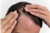 Alopecie difuză - dinamica efluviului telogen, de la declanșare la regenerare