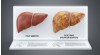 Steatoza hepatică de grad 2 sau 1: Diagnostic și tratament pentru ficatul gras. Cum se curăță ficatul de grăsime?