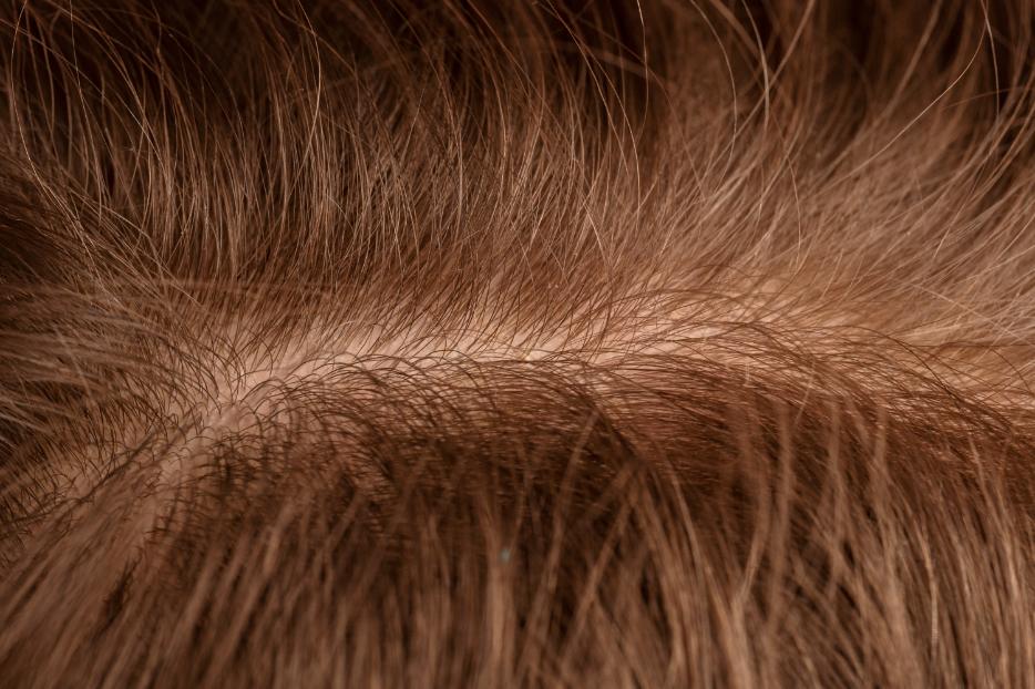 alopecie femei, par difuz